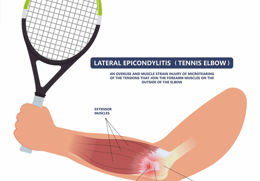 Tennis-elbow-1